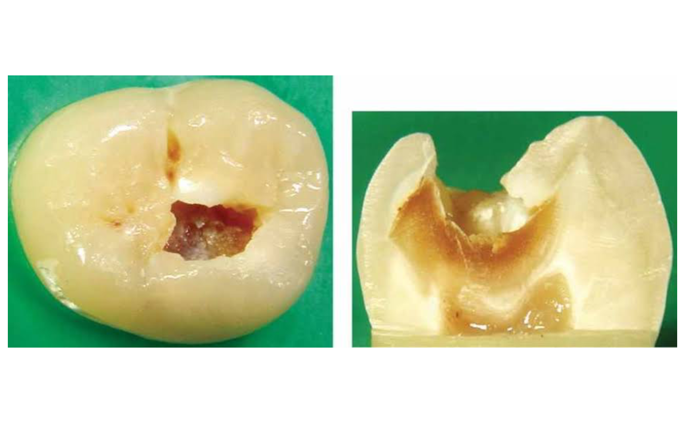 『象牙質のむし歯C2の治療方法』
