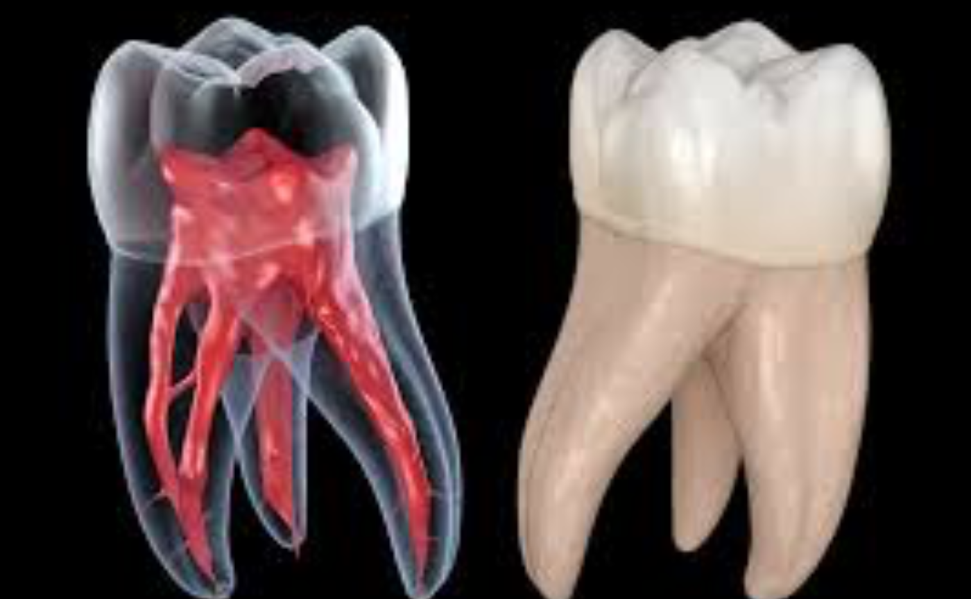 神経まで進行したむし歯C3の治療方法