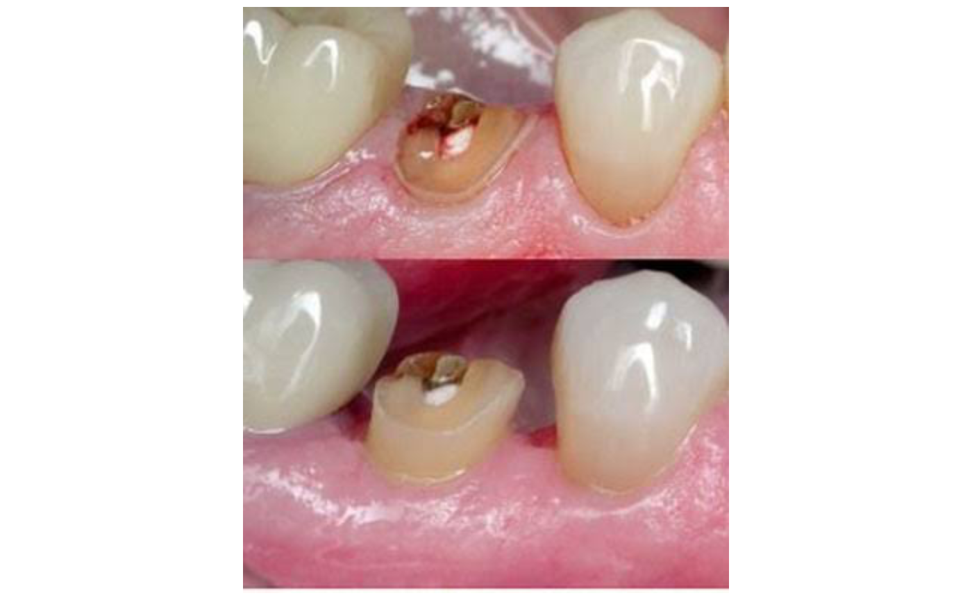 重度に進行したむし歯C4の治療方法②